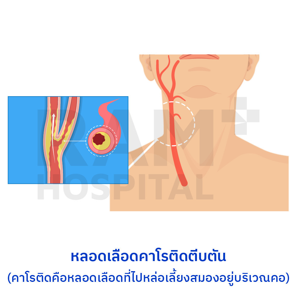 โรคหลอดเลือดสมอง