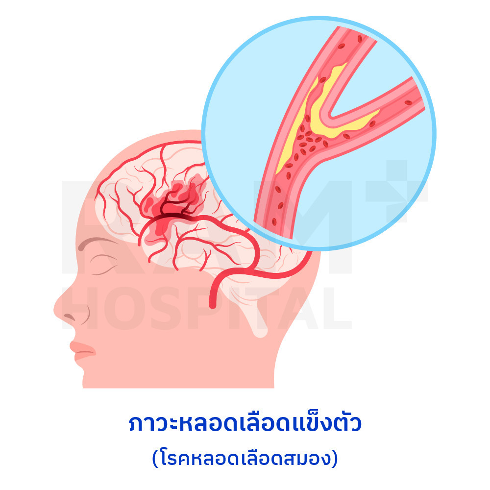 โรคหลอดเลือดสมอง