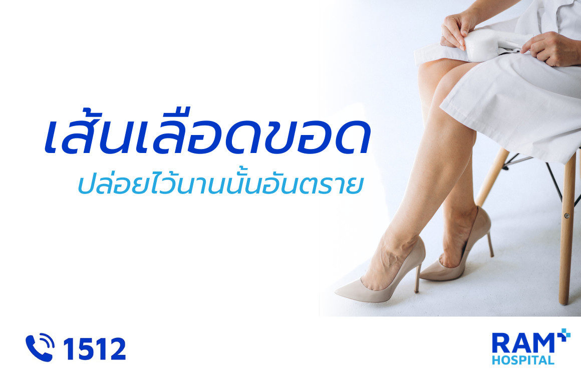 เส้นเลือดขอด